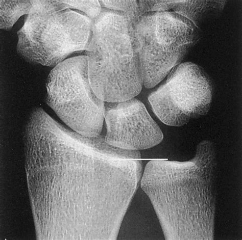 ulnar impaction special test|ulnar sided wrist pain orthobullets.